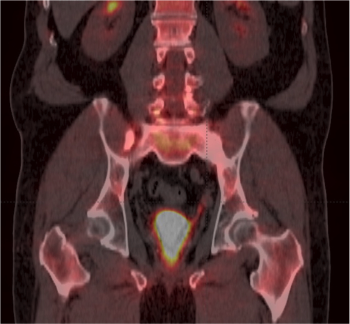 axumin pet scan radiology
